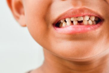 Child with lose tooth
